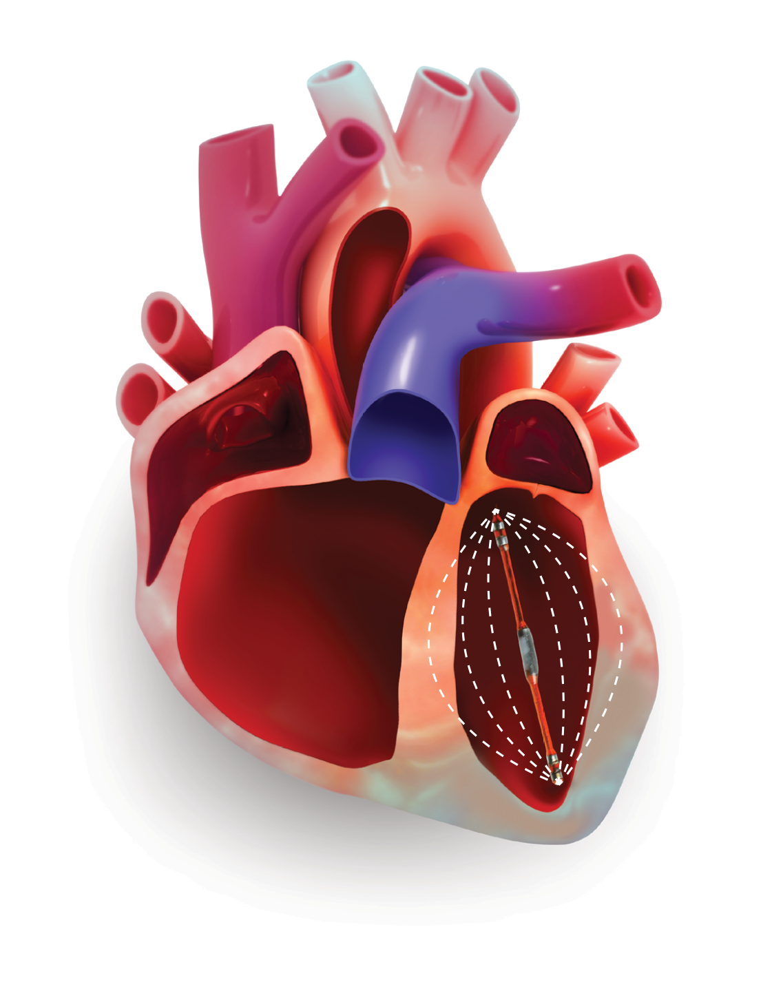 心脏的压力-容积导管